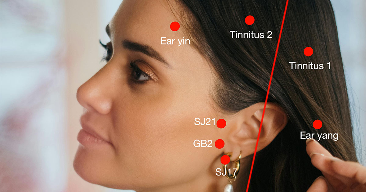 Hoe behandel je tinnitus met acupunctuur?